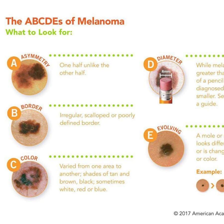 ABCDEs of Melanoma Skin & cancer center of scottsdale