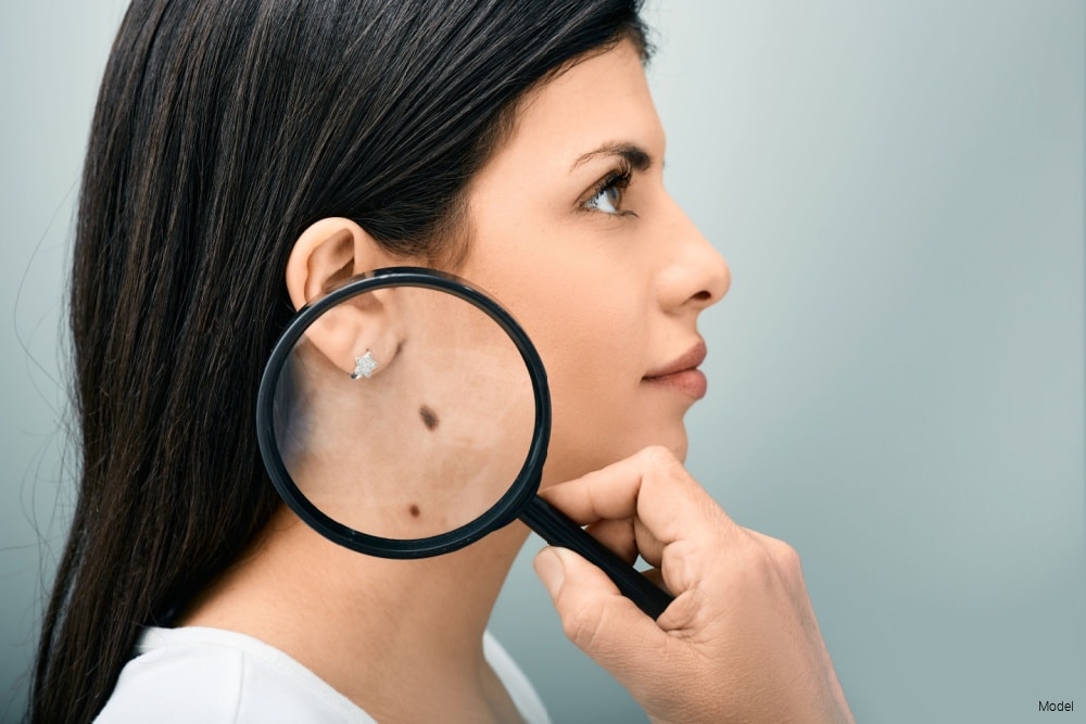Woman with magnifying glass showing mole and birthmark on her body for  melanoma awareness.