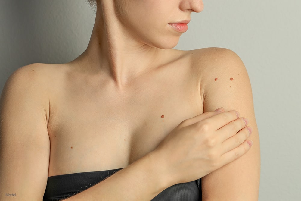 woman with spots on her chest and shoulder