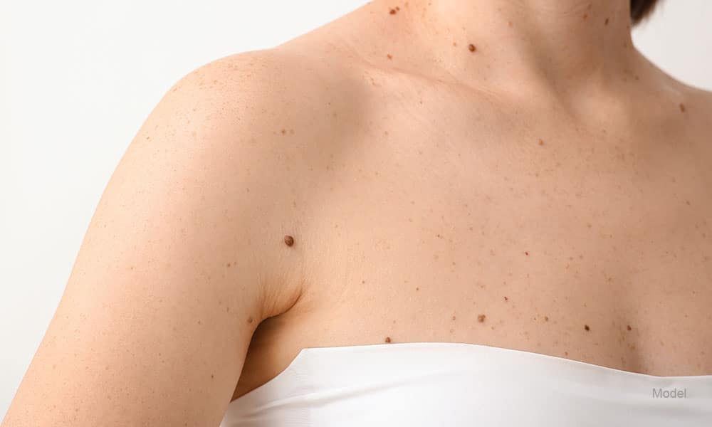 Woman with moles on her body against white background